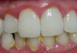 Cao răng là gì? Đâu là cách Lấy Cao Răng hiệu quả nhất hiện nay