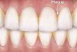 Xem ngay: Mảm bám răng là gì và các biện pháp “thổi bay” mảm bám răng phổ thông