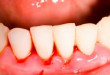 Nguyên nhân chảy máu chân răng và cách điều trị triệt để nhất