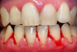 Có thể bạn sẽ bị sốc khi biết chảy máu răng là bệnh gì?