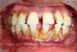 Dụng cụ lấy cao răng tại phòng khám nha khoa uy tín ở Hà Nội