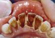 Lấy cao răng bằng máy siêu âm cho hàm răng trắng sáng nổi bật