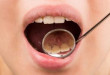 Những nguyên nhân hình thành vôi răng KHÔNG NGỜ ĐẾN