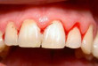 Tại sao bị chảy máu chân răng? Bắt bệnh chính xác và cách điều trị