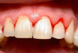 Hiện tượng chảy máu chân răng – Dấu hiệu cảnh báo bệnh răng miệng nguy hiểm