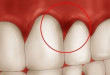 Những biểu hiện của bệnh viêm chân răng đừng nên coi thường