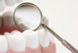 Liệu bạn đã thực sự biết được bọc răng là gì hay chưa?