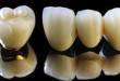 Bọc răng sứ titan giá bao nhiêu và kết quả như thế nào? >> Tìm hiểu ngay