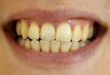 Những nguyên nhân làm cho răng bị vàng và cách khắc phục hiệu quả