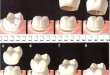 Bọc răng là gì? – Những điều bạn cần biết trước khi quyết định bọc răng sứ