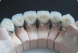 Bạn sẽ bất ngờ khi biết quy trình bọc răng sứ như thế nào chuẩn quốc tế?
