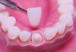 Bọc răng sứ mất bao lâu tại nha khoa uy tín và chất lượng?