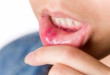 Những cách chữa nhiệt miệng TRIỆT ĐỂ bạn không thể không biết