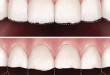 Những ảnh hưởng tiêu cực khi nghiến răng