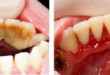 Điều trị viêm nướu bằng cách lấy cao răng