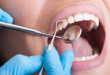 Lấy cao răng đen bao nhiêu tiền? – Chi phí 1 lần thực hiện