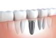Địa chỉ trồng răng implant ở đâu tốt và uy tín tại Hà Nội