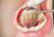 Lấy cao răng lần đầu có đau không? Có hại cho men răng không?