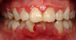Bị tụt nướu răng – Điều trị NHANH CHÓNG và TRIỆT ĐỂ nhất