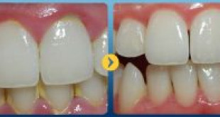 Cạo vôi răng là gì? & Vai trò không thể bỏ qua của cạo vôi răng
