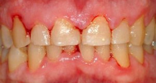 Cảnh báo các nguy hiểm tiềm tàng khi chảy máu răng nhiều