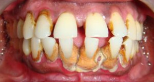 Đừng chần chờ có nên lấy cao răng không vì những thông tin cực SHOCK