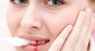 Khẩn cấp: Đánh răng bị chảy máu có phải là bệnh lý nguy hiểm không?