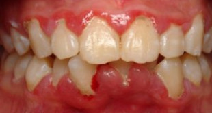 Giải mã bệnh nha chu là gì & cách điều trị bệnh nha chu hiệu quả