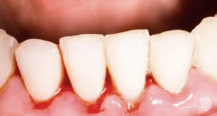 Những cách chữa chảy máu chân răng hiệu quả, cấp tốc