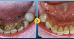 Chi phí lấy vôi răng được cập nhật mới nhất hiện nay