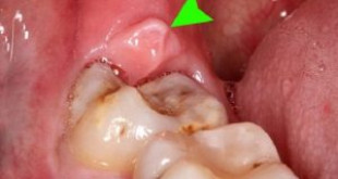 Sưng mộng răng thực sự là một chứng bệnh bạn cần phải đề phòng
