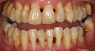 Tụt lợi có thể nguy hiểm đến tính mạng mà bạn không lường trước được