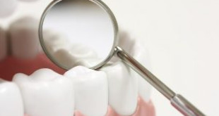 Liệu bạn đã thực sự biết được bọc răng là gì hay chưa?
