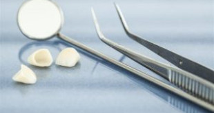 Bọc răng sứ mất bao lâu? [Mốc thời gian chuẩn xác nhất]