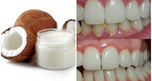 3 cách lấy cao răng bằng dầu dừa hiệu quả ngay lập tức