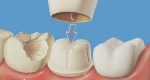 Chia sẻ từ A-Z về chụp răng sứ thẩm mỹ >>>> Xem nhanh