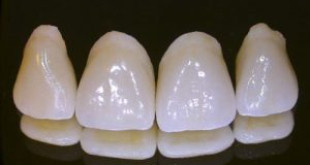 Sự thật về bọc răng sứ alumina có tốt và bền không? >>> Tư vấn tư chuyên gia
