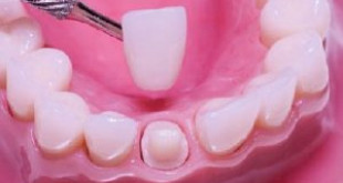 Bọc răng sứ mất bao lâu tại nha khoa uy tín và chất lượng?