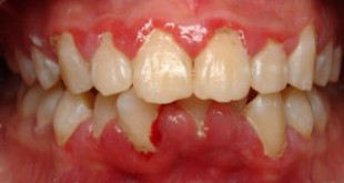 Viêm nướu răng – Cẩn thận nếu không muốn mất răng vĩnh viễn