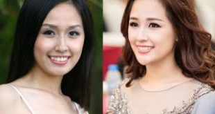 Khuôn mặt sau khi niềng răng sẽ thế nào? Cùng tìm hiểu niềng răng đẹp cỡ nào?