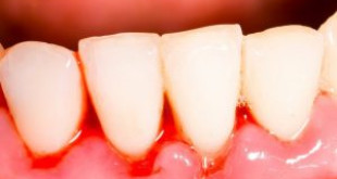 Cách điều trị chảy máu chân răng ngay tại nhà