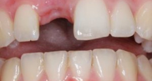 Thực hư việc mất răng làm tăng khả năng gây ung thư