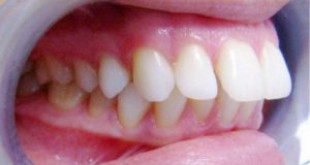 Tác hại gây ra lệch khớp cắn