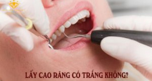 Lấy cao răng răng có trắng không? – Đây chính là sự thật