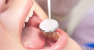 Không cần lấy cao răng có được không? – Bác sĩ tư vấn giúp tôi với