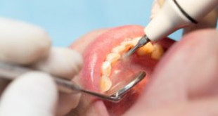 Lấy cao răng đắt không? Xem ngay để giải đáp băn khoăn