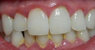 Cao răng là gì? Đâu là cách Lấy Cao Răng hiệu quả nhất hiện nay