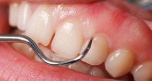 Những thắc mắc xung quanh việc lấy cao răng bạn buộc phải biết