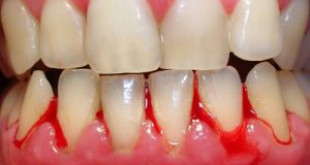 Bà bầu bị sưng nướu răng nên chữa như nào cho an toàn?