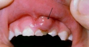 Bé bị sưng nướu răng – Bố mẹ chớ chủ quan với tình trạng này